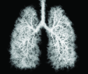 New Lung Cancer Screening Recommendations